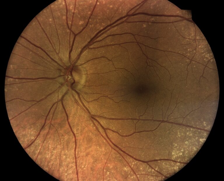 Imagem de um exame de retinografia simples