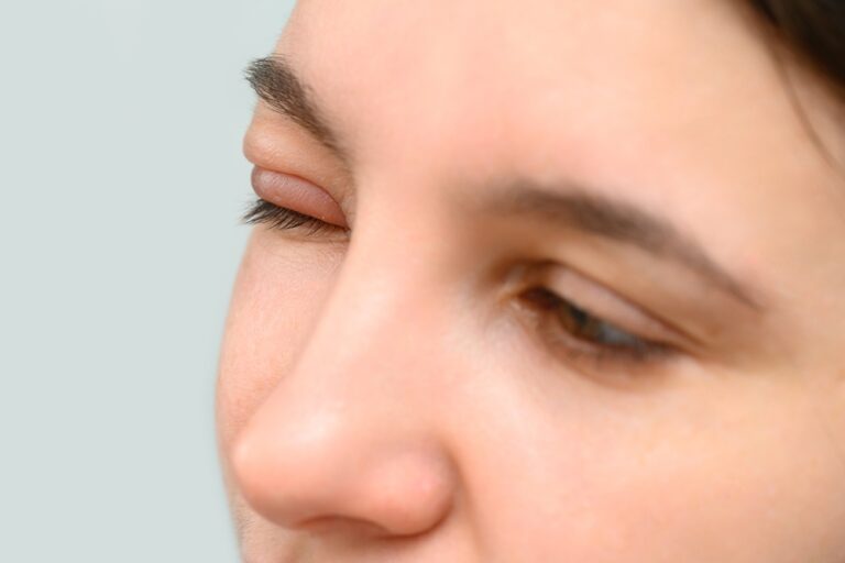 Imagem de uma paciente com dermatocalaze