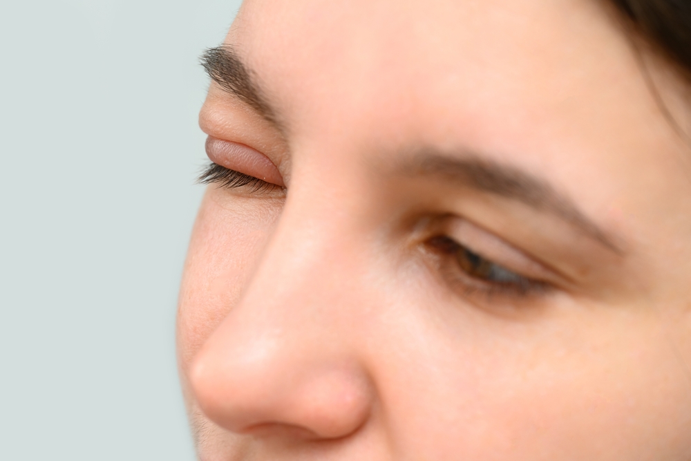 Dermatocalaze: causas, sintomas e tratamentos