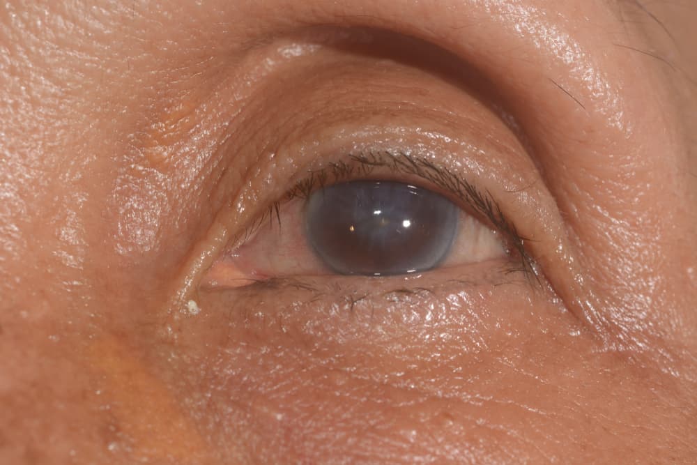 O que é o edema de córnea?