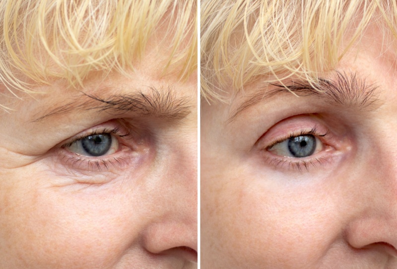 Como é o antes e depois da blefaroplastia?