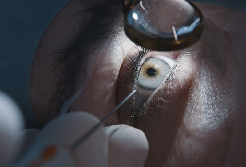 Cirurgia de catarata: preço em 2026