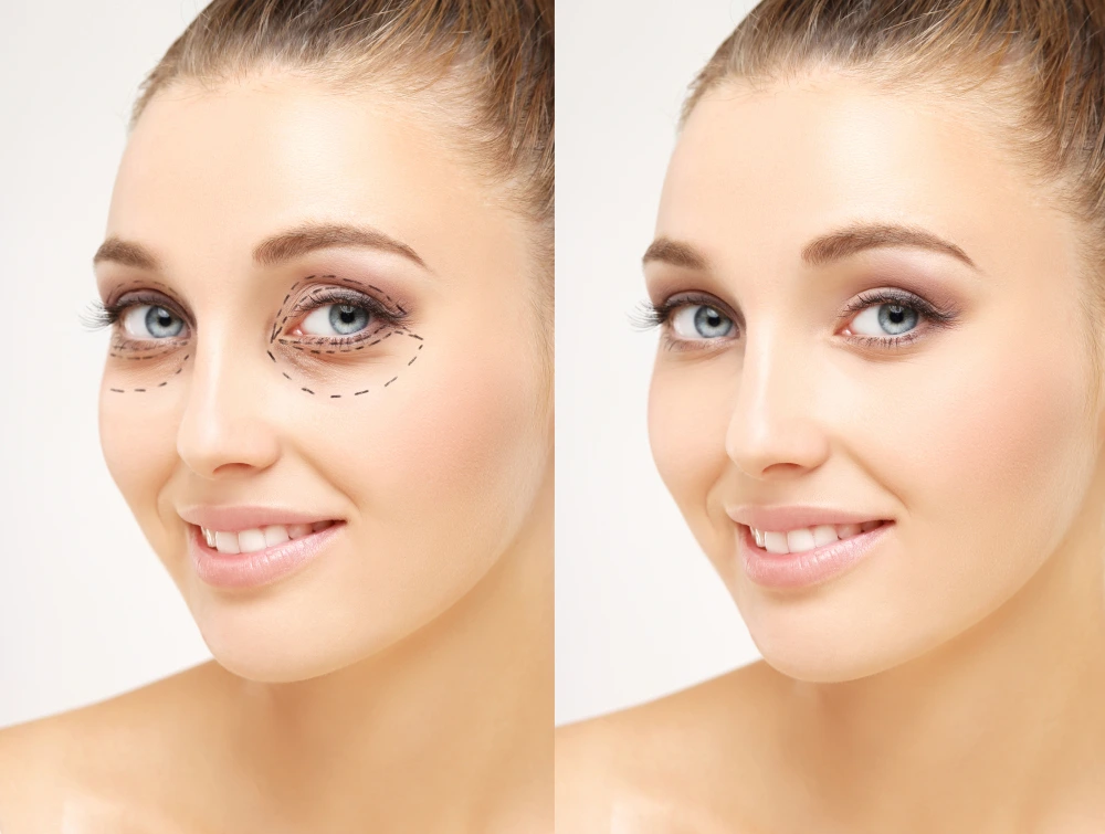 Blefaroplastia funcional: o que é, como funciona e quando é indicada