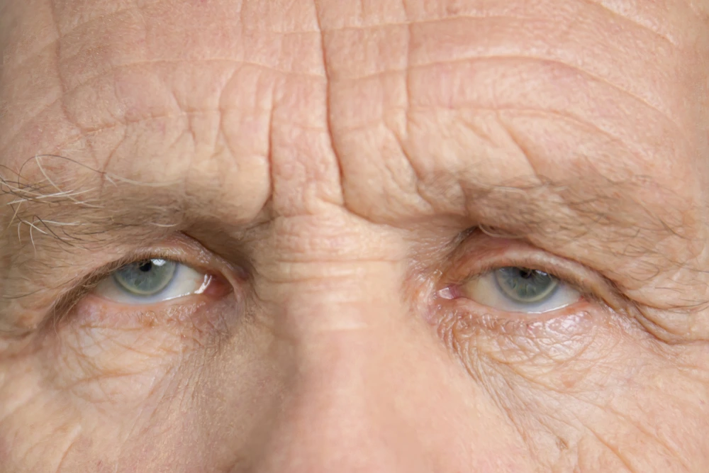 Dermatocalase severa: o que é, causas, sintomas e tratamento