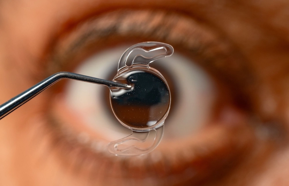 Lentes intraoculares: tipos e como funcionam
