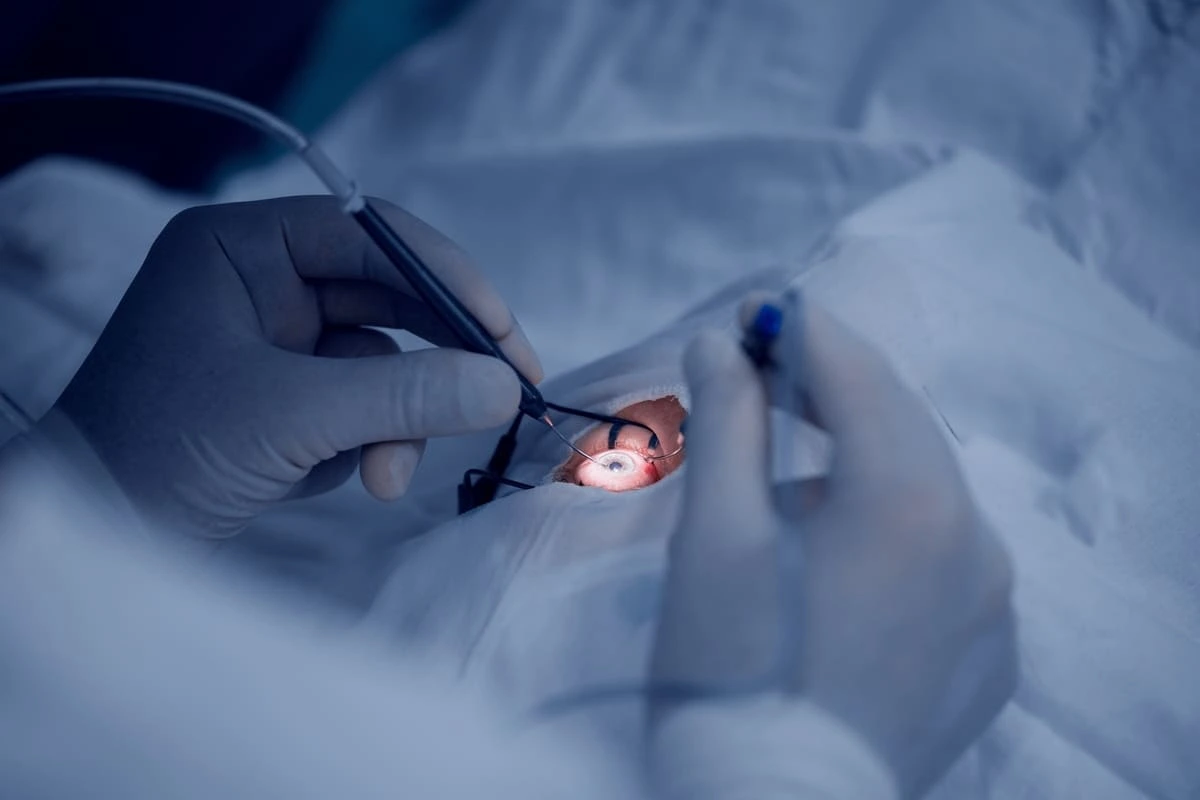 Cirurgia de miopia: como funciona, recuperação e quando fazer